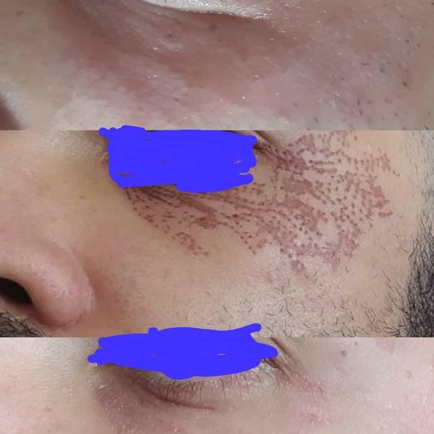 Registro de procedimento realizado na região dos olhos