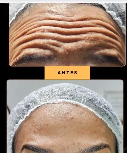 Comparativo da região da testa antes e depois do tratamento