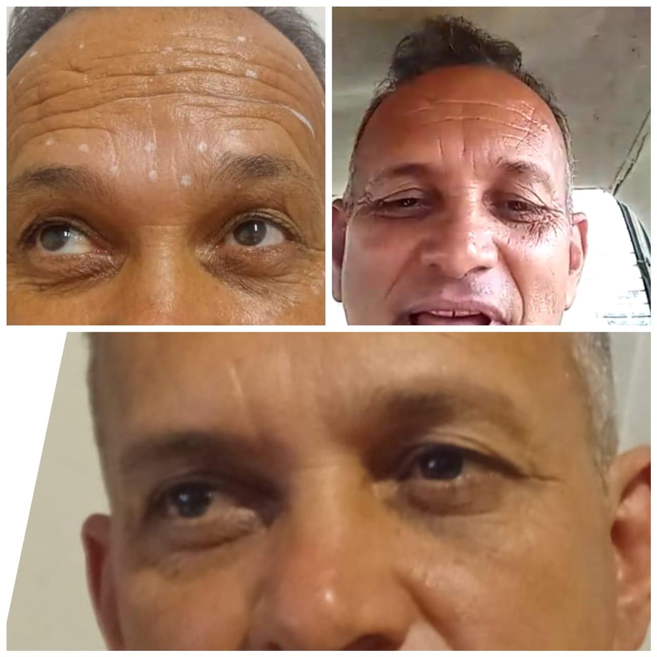 Registro da evolução de tratamento na região dos olhos