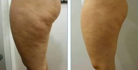 Comparativo de evolução do tratamento corporal na região de bananinha e culote